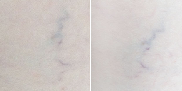 Remescar Spider Veins Treatment Review A Mum Reviews