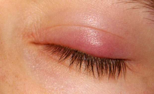 What is Chalazion How to Treat it