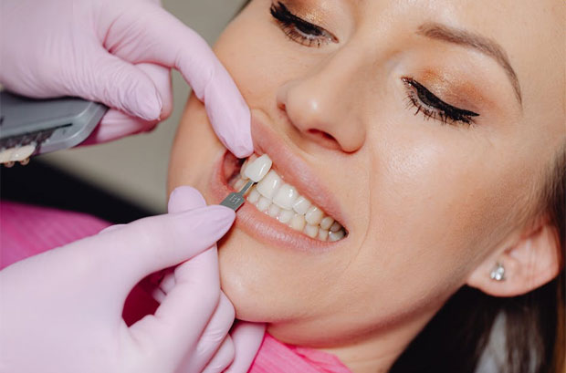 Everything You Need to Know About Veneers