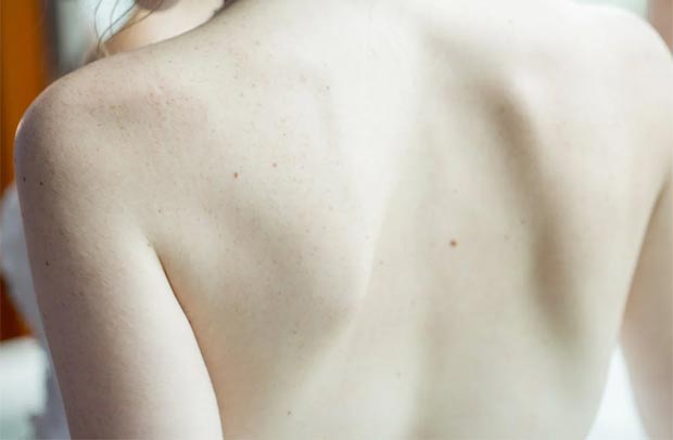 Choosing the Right Specialist for Your Skin Tag Removal