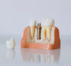 What Are Dental Implants? A Comprehensive Guide to Permanent Tooth Replacement
