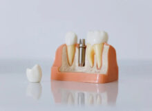 What Are Dental Implants? A Comprehensive Guide to Permanent Tooth Replacement